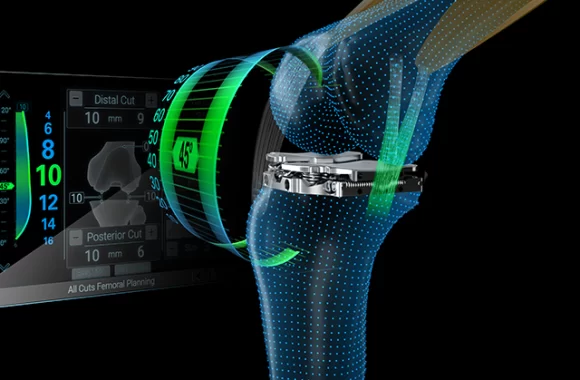 Bonezone article featuring Intelligent Implants CEO Ben Hertzog discussing the future of orthopedics.